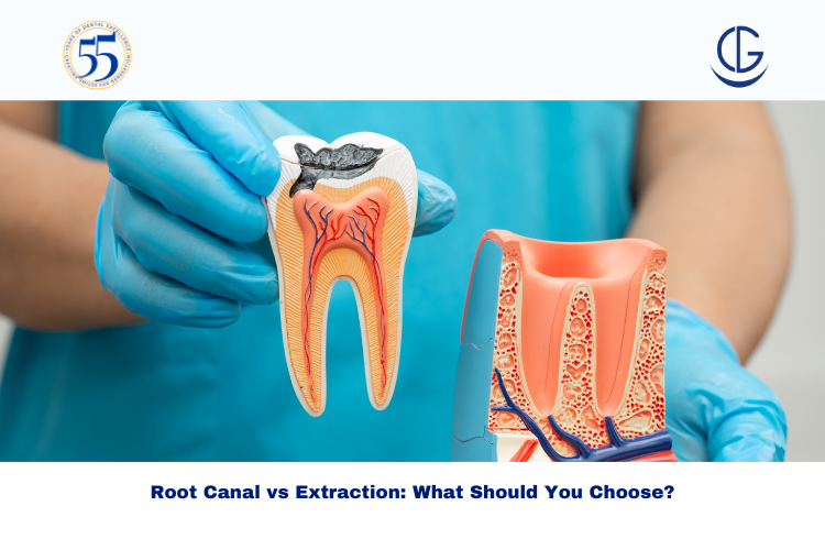 Root Canal vs Extraction