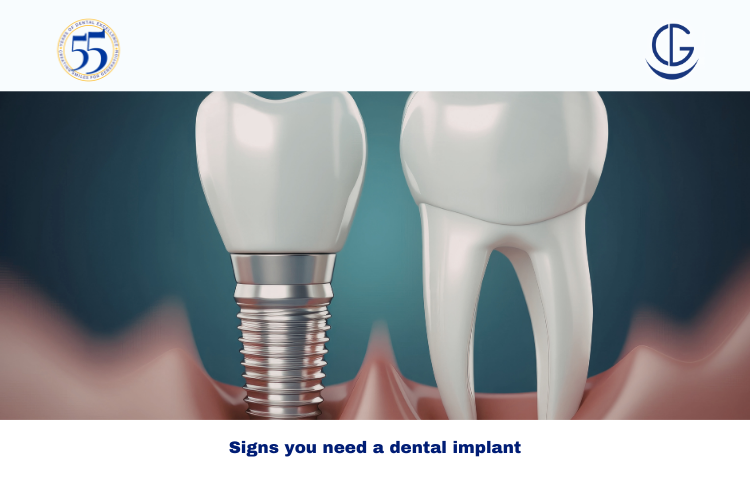 Signs you need a dental implant