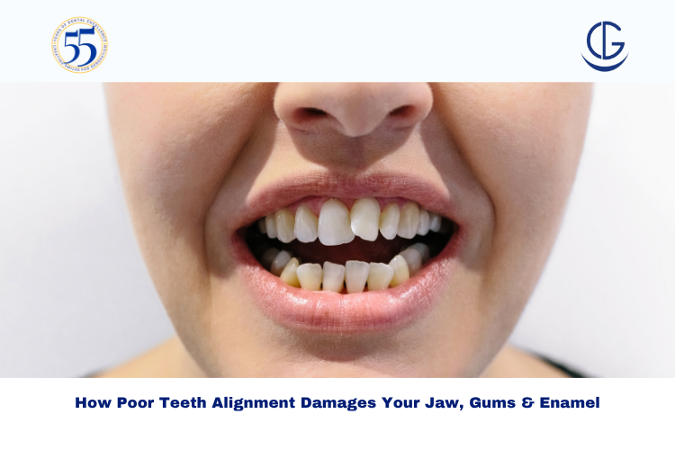 Teeth Alignment