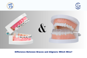 Difference Between Braces and Aligners