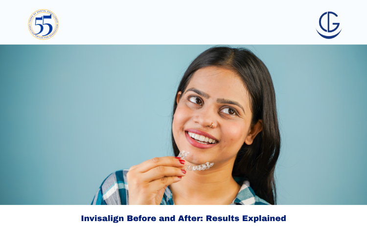 Invisalign Before and After