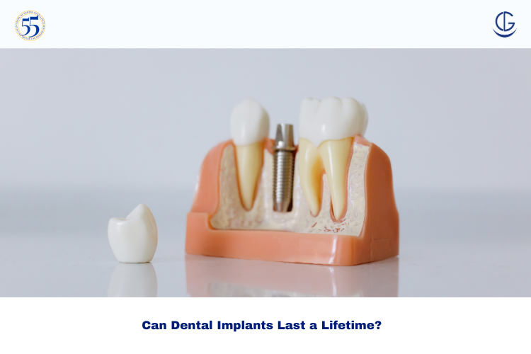 How Long Do Dental Implants Last?