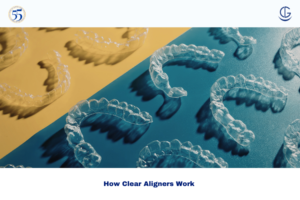 clear aligners
