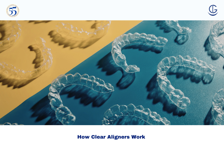 clear aligners