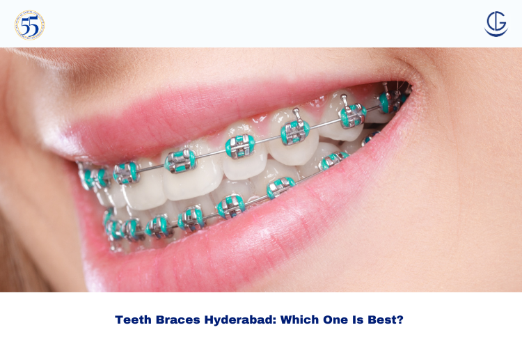 Teeth Braces Hyderabad