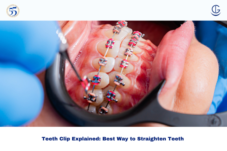 teeth clips