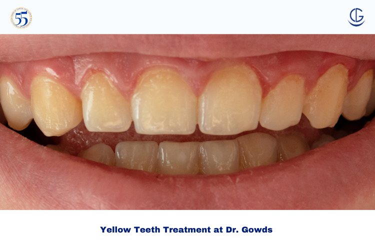 How to Remove Yellow Teeth