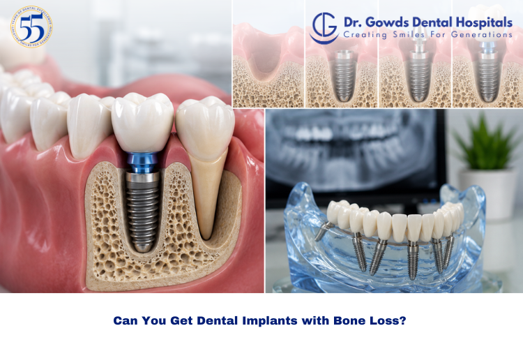 Bone Loss and Dental Implants