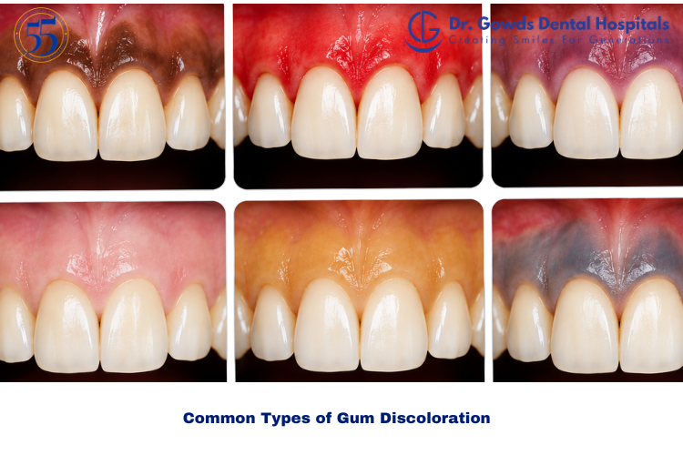 Types of Gum Discoloration