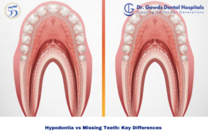 Hypodontia vs Missing Teeth
