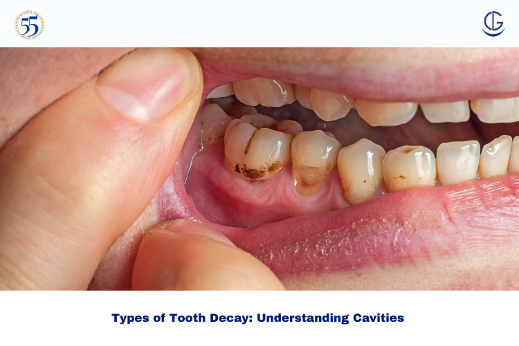 Types of Tooth Decay