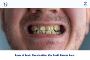 Types of Tooth Discoloration