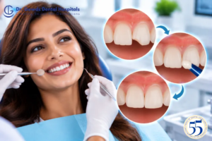 How long does dental bonding last