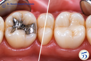 Metal Fillings vs Tooth-Colored Fillings